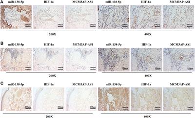 LncRNA-MCM3AP-AS1 Promotes the Progression of Infantile Hemangiomas by Increasing miR-138-5p/HIF-1α Axis-Regulated Glycolysis